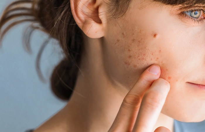 Causes of Blackhead formation