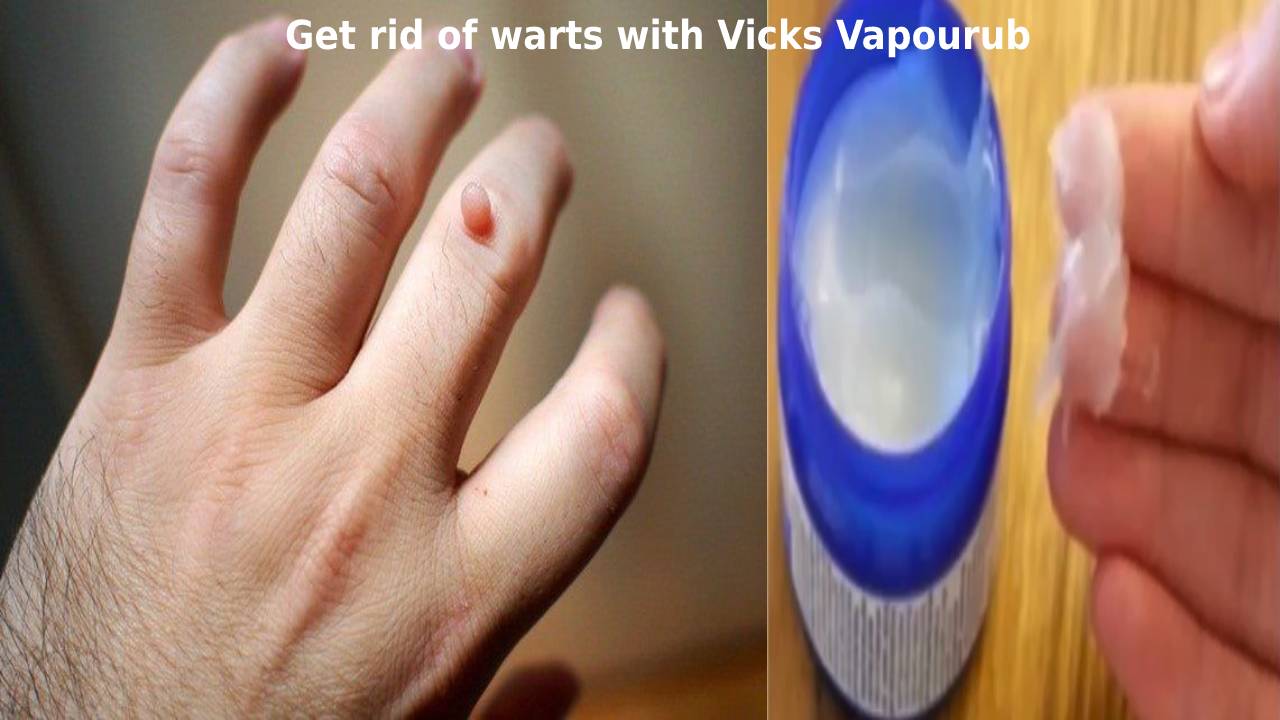 Get rid of warts