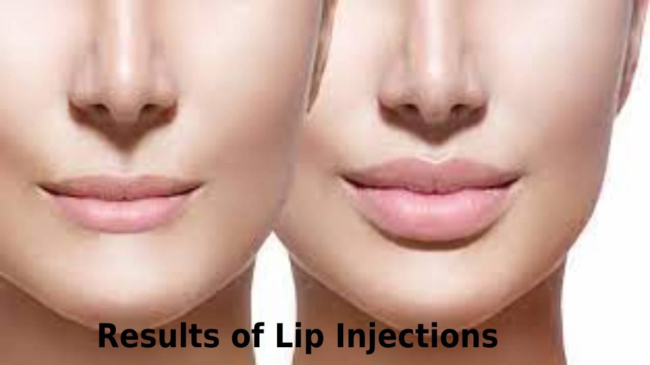 Results of Lip Injections