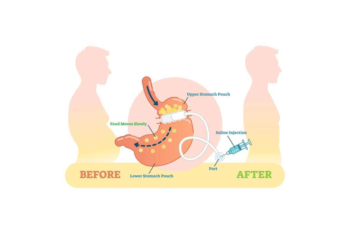 Considering bariatric tourism? A gastric sleeve in Latvia is the right choice!