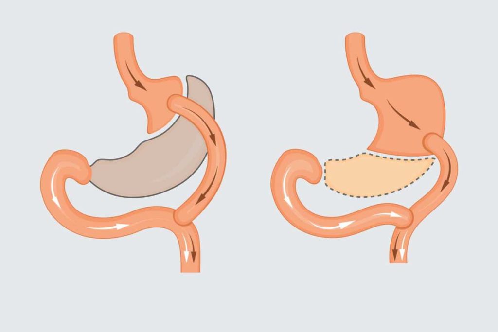 Weight Loss Surgery Options