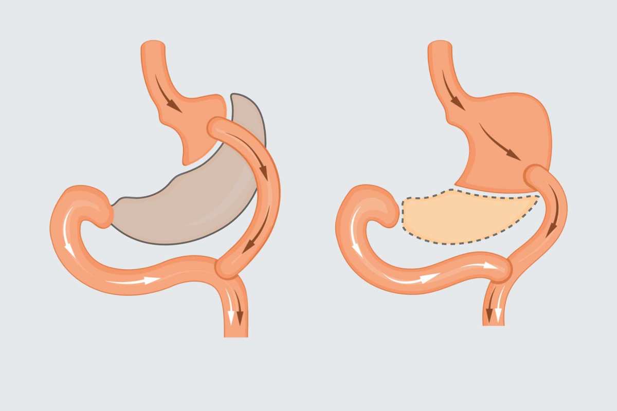 Weight Loss Surgery Options: The Complete Guide