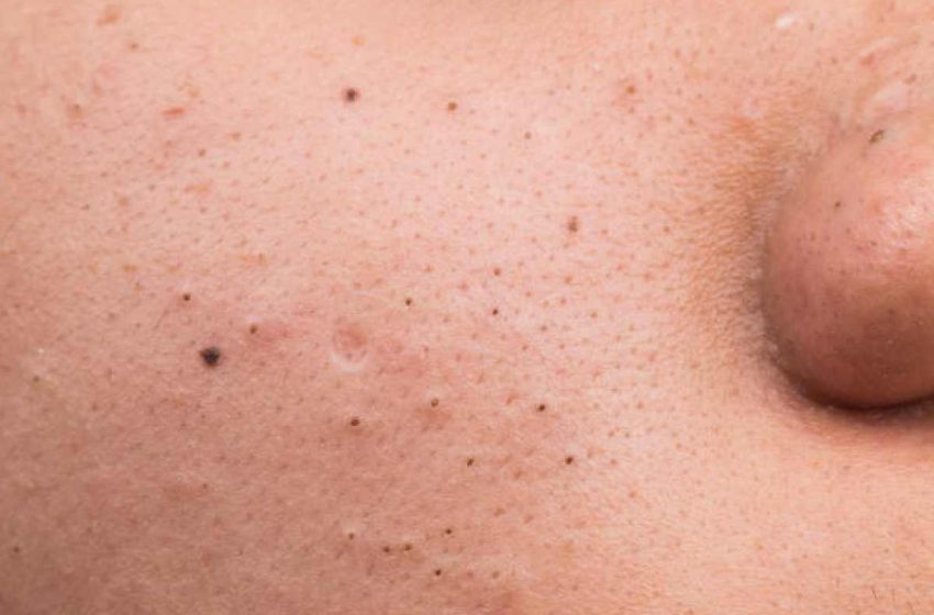  Popping Blackheads: The Good, the Bad, and the Ugly