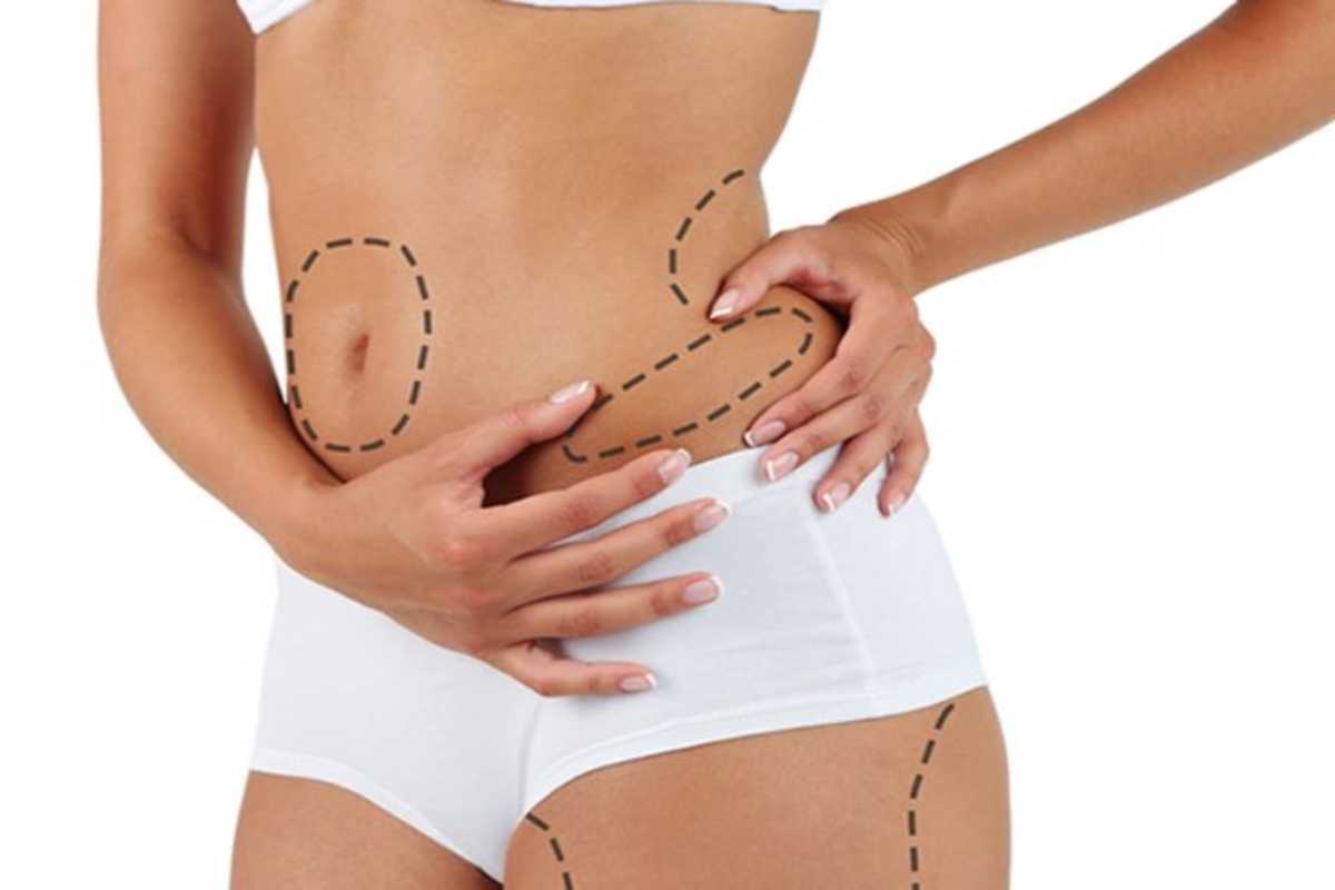 What is Liposuction?